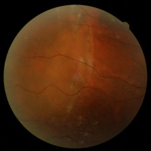 Note the whitish sheen over the left half of the retinal photo.  This is the part of the retina that has detached.   